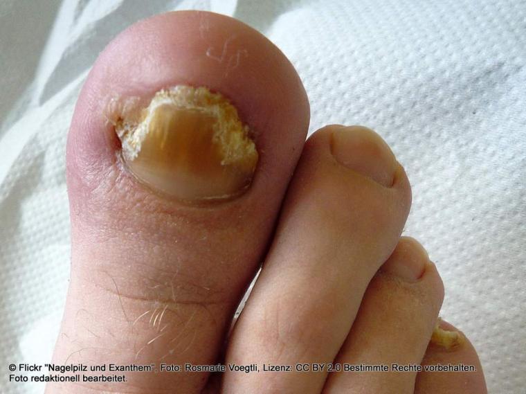 Nagelpilz: Erkennen und behandeln und vorbeugen Nagelpilz: Erkennen und behandeln und vorbeugen